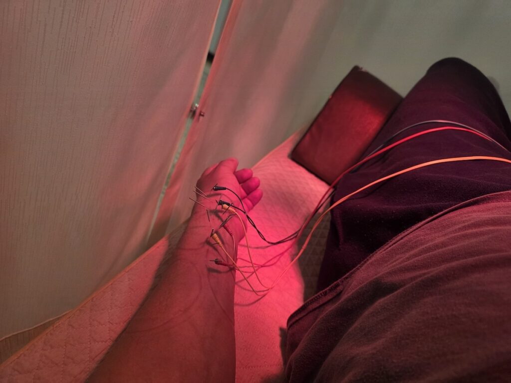 A candid photograph of a patient receiving Acupuncture in Seoul at a Korean medicine clinic. The patient's left forearm and leg are on a treatment bed under a warming red lamp. Several fine acupuncture needles are inserted along the arm, connected by colored electrical leads for E-Acupuncture, demonstrating a key treatment method.