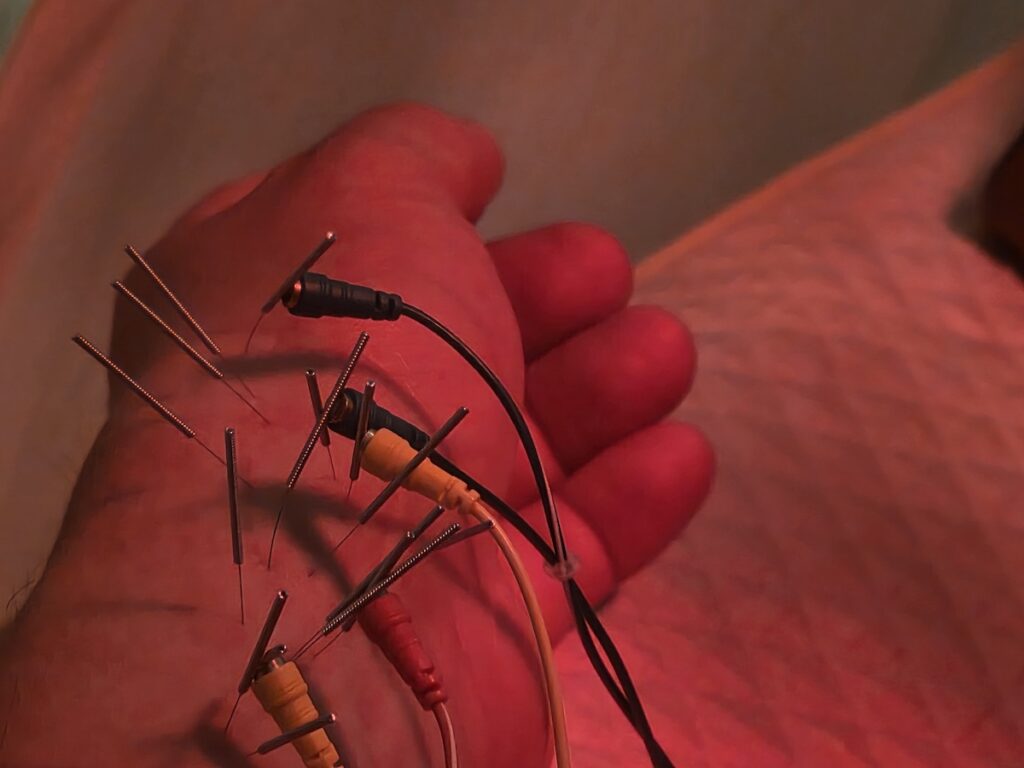 Close-up of Acupuncture in Seoul - Electrical stimulation needles for sprained wrist treatment. A close-up view focusing on a hand receiving Acupuncture in Seoul, Korea. The hand is illuminated by a warm red healing lamp, highlighting numerous sterile filaments inserted into the skin between the thumb and index finger. Electrical lead wires are clipped to the needles for stimulating blood circulation and pain relief.